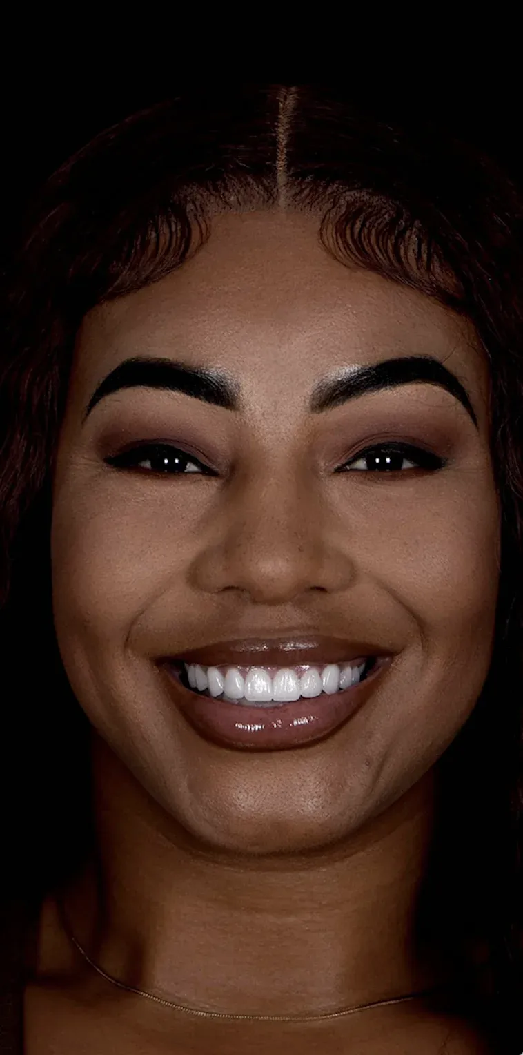 Dental Veneers before-after2