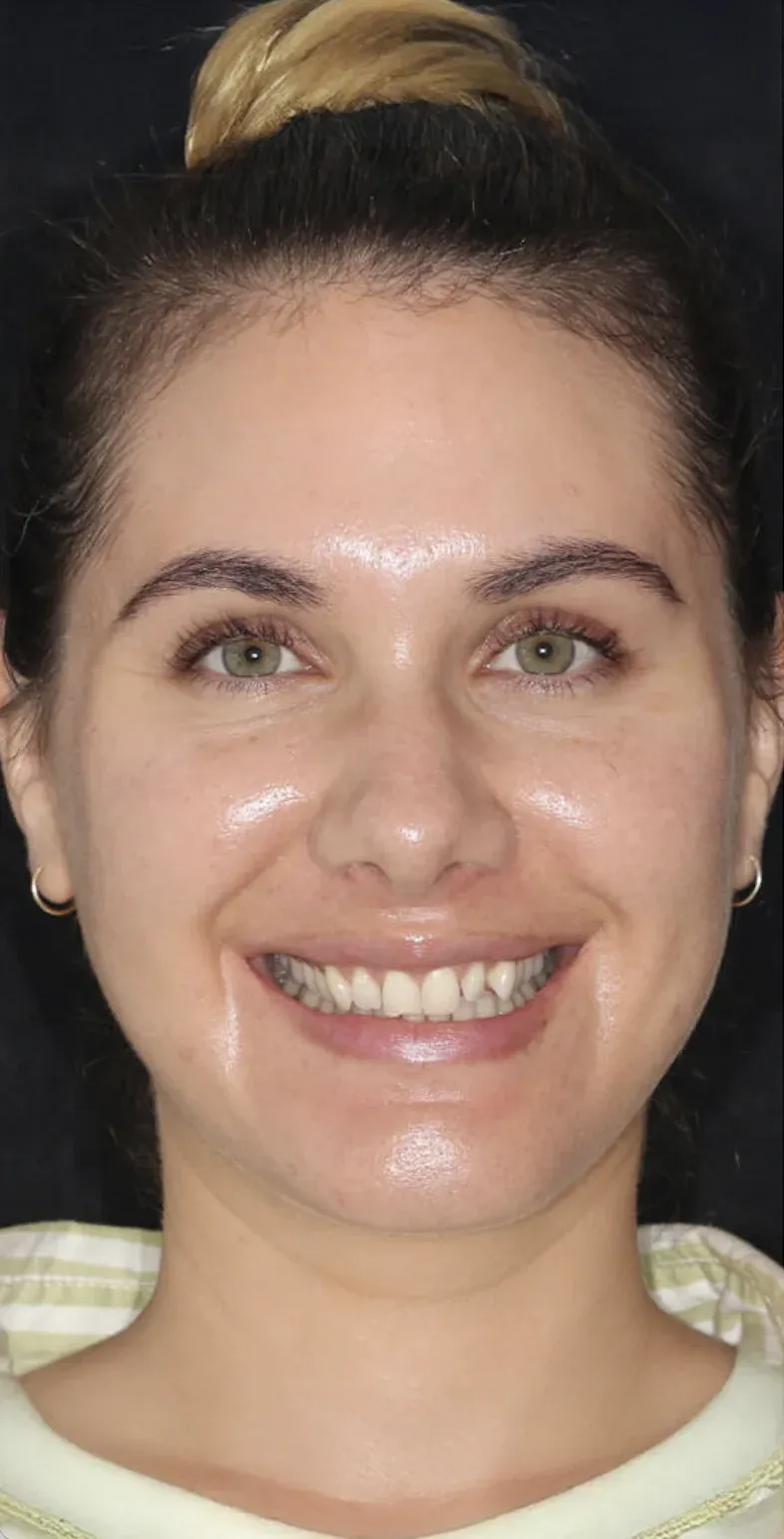 Dental Veneers before-after3