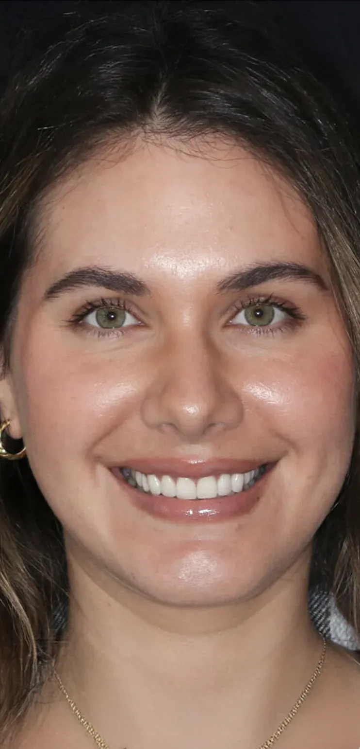 Dental Veneers before-after4