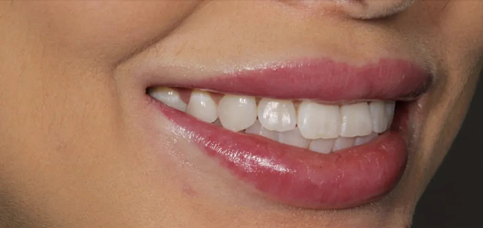 Dental Veneers before-after5