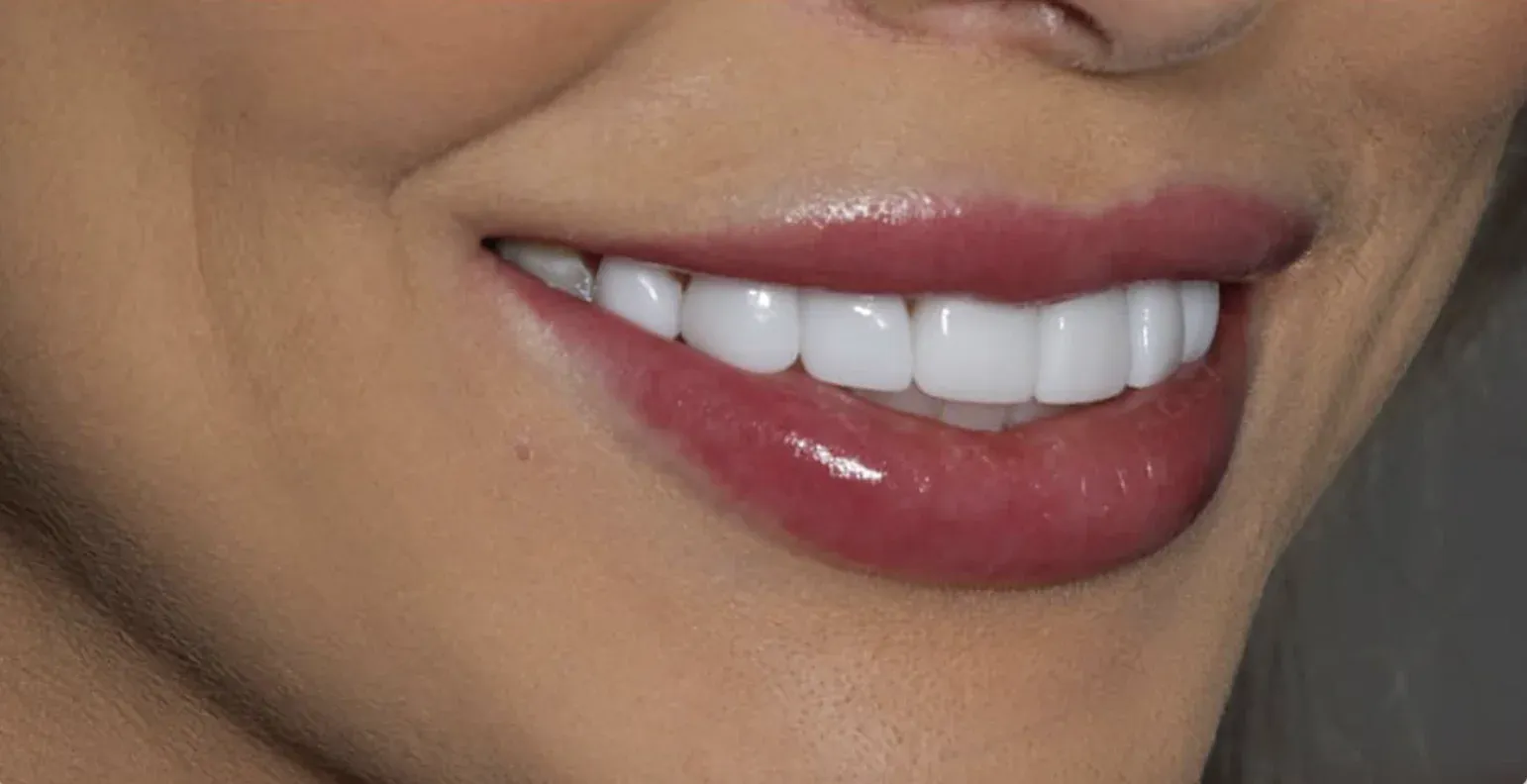 Dental Veneers before-after6