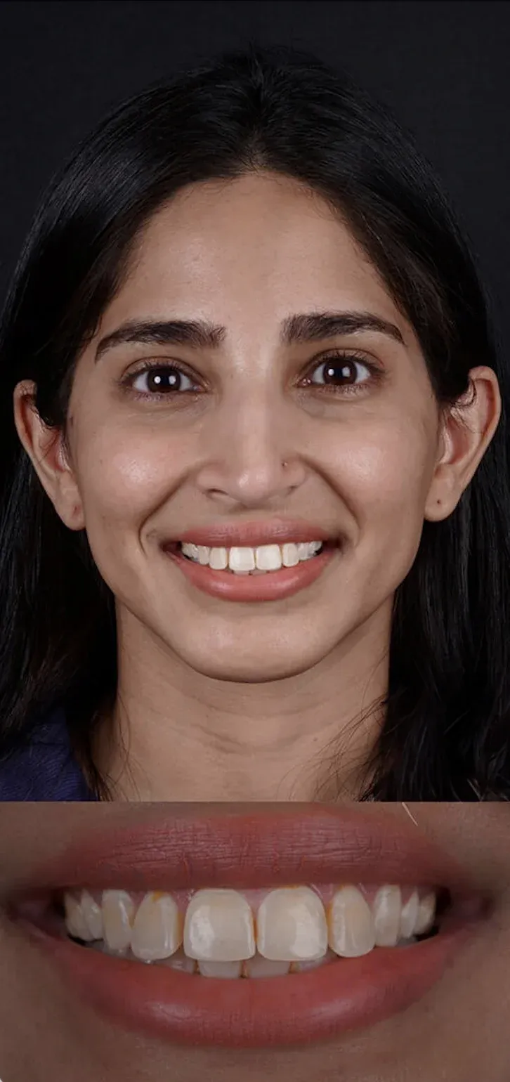 Dental Veneers before-after7