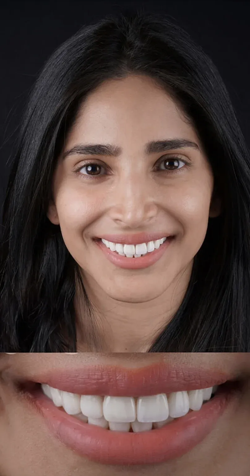 Dental Veneers before-after8