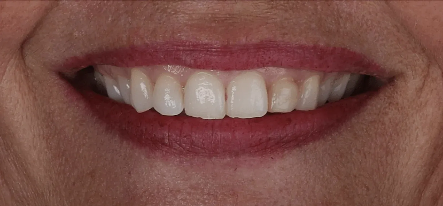 Dental Veneers before-after9