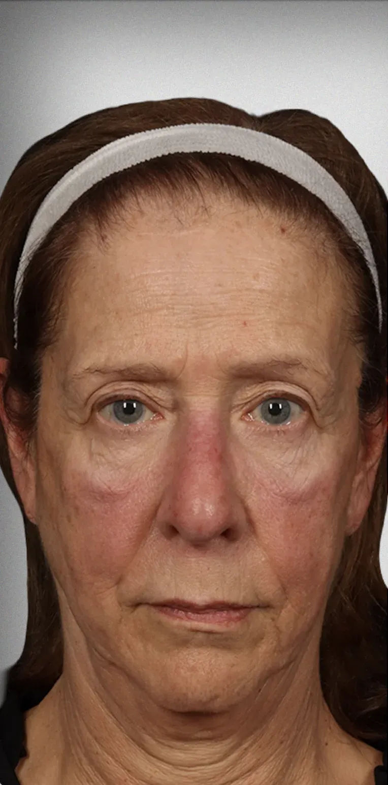 Eyelid Surgery