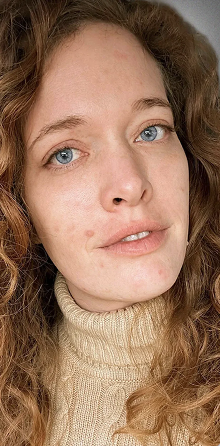 Eyelid Surgery10