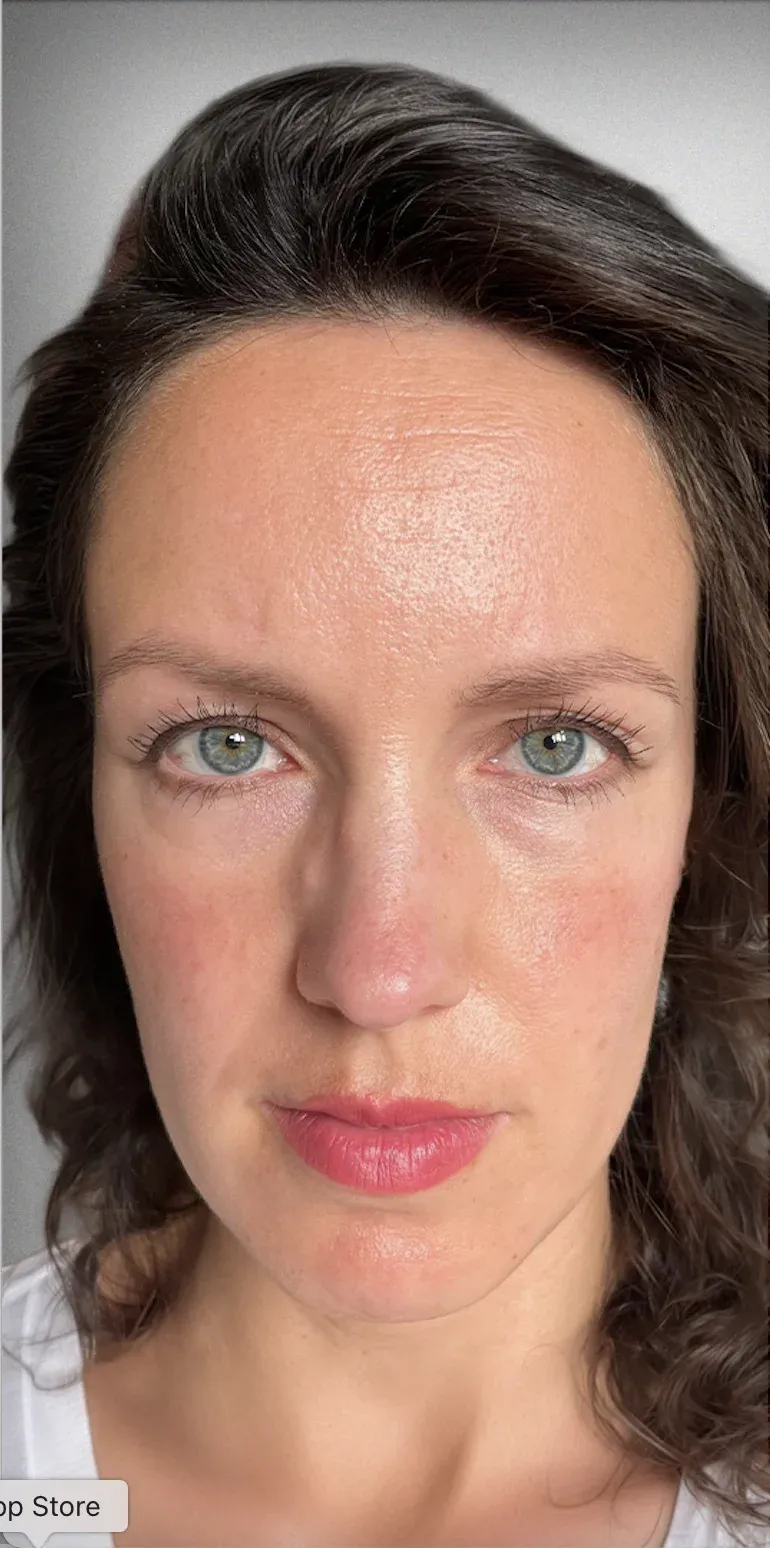 Eyelid Surgery11