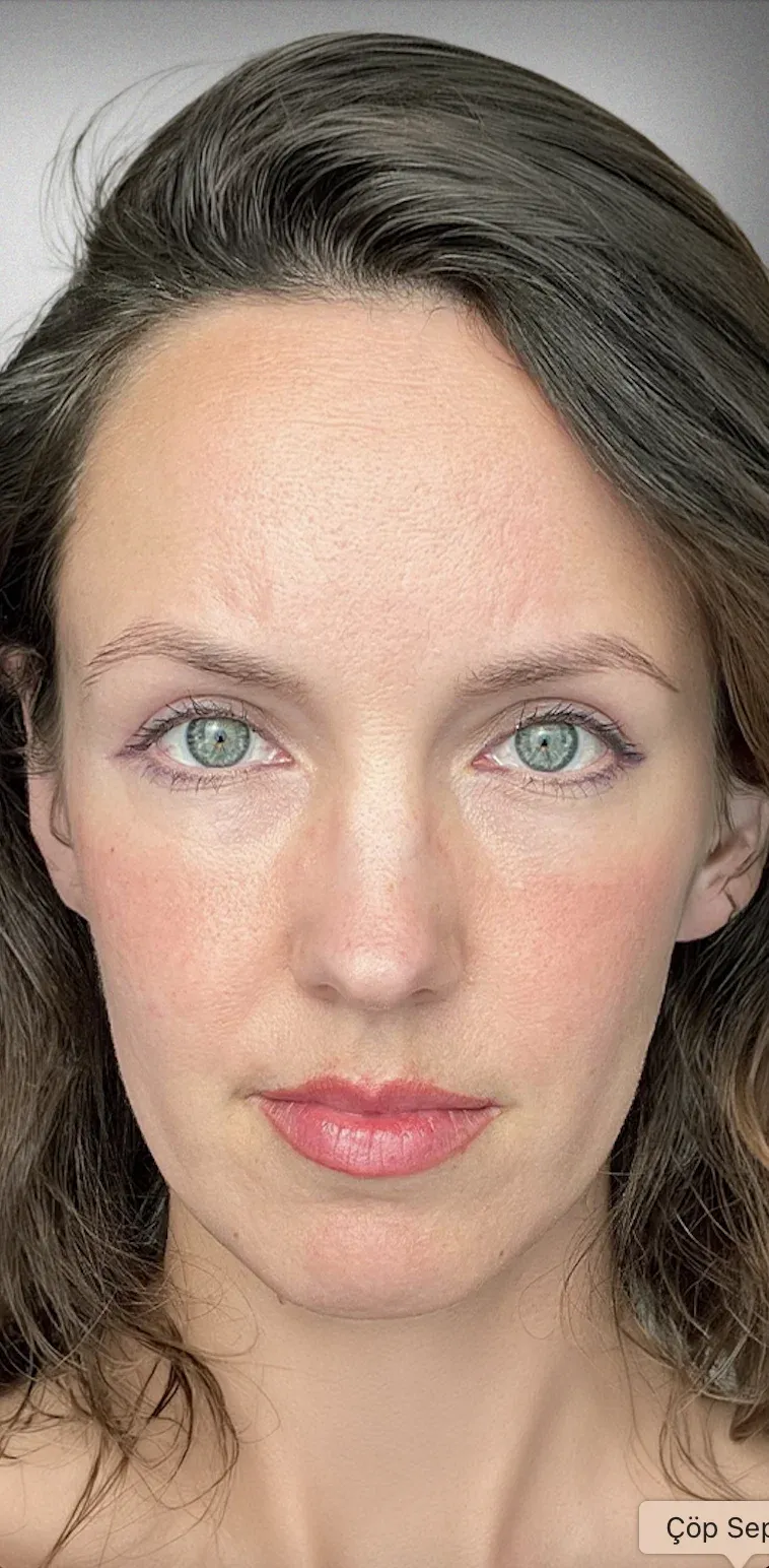 Eyelid Surgery12