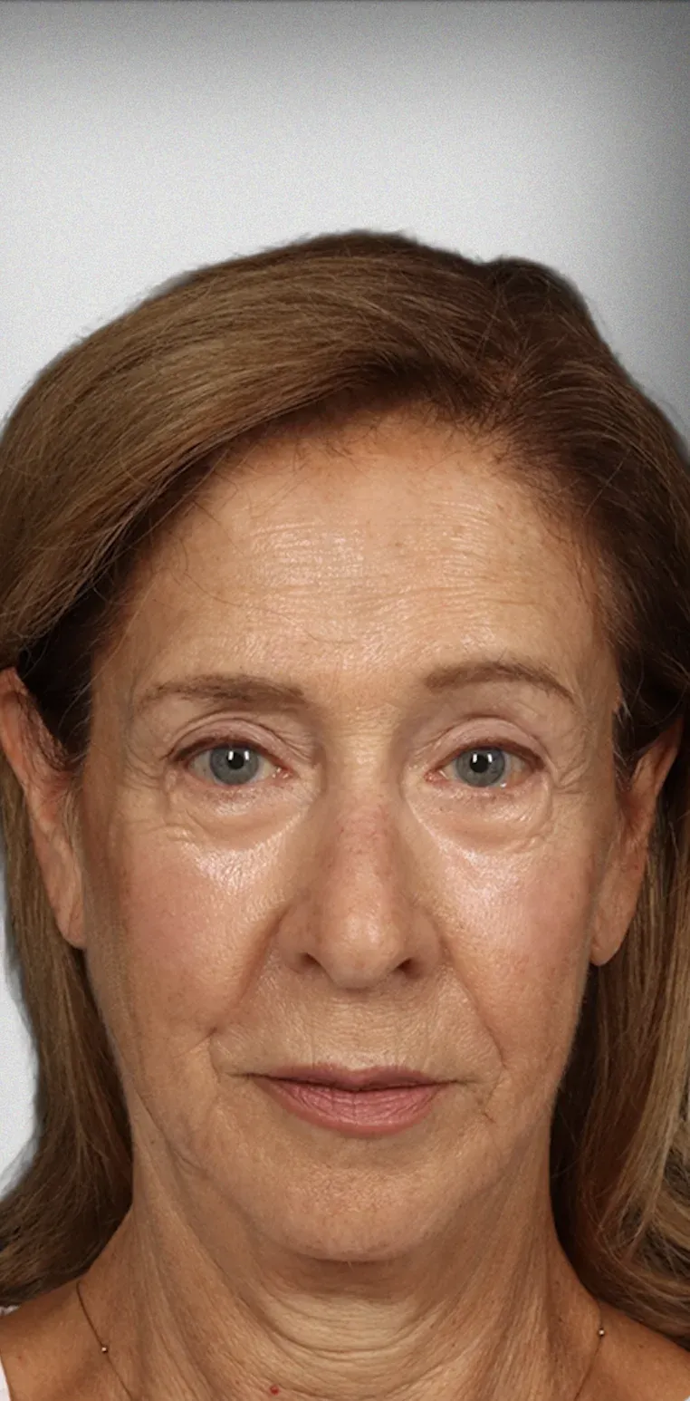 Eyelid Surgery2
