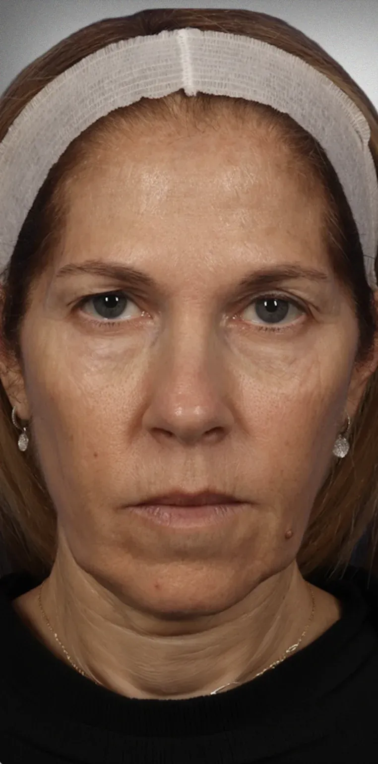Eyelid Surgery3
