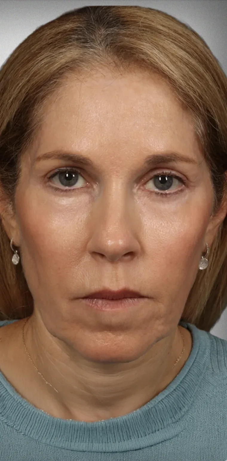 Eyelid Surgery4