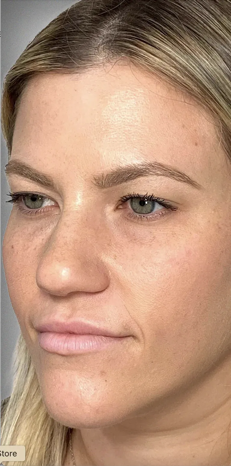 Eyelid Surgery5