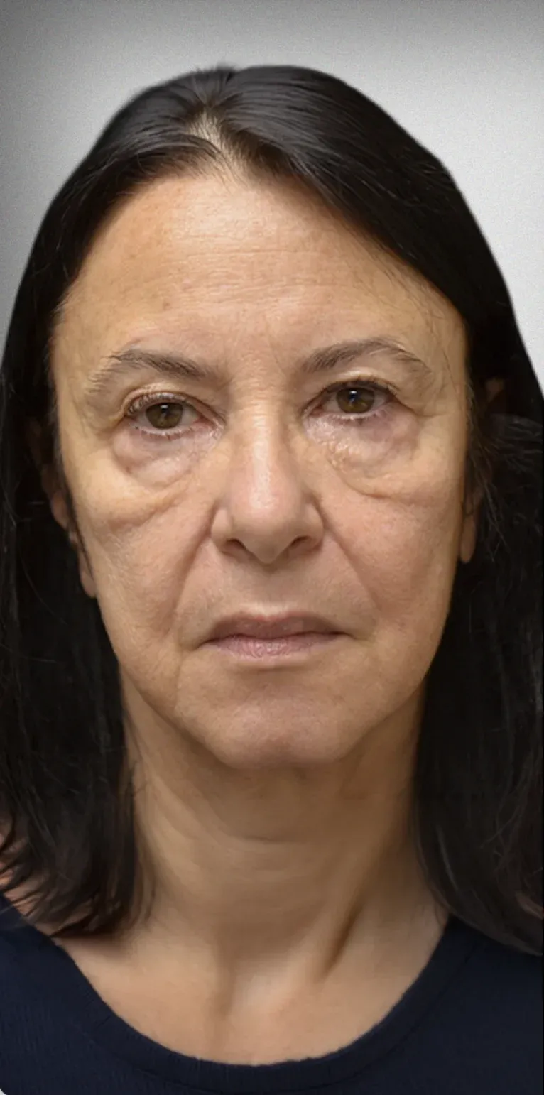 Eyelid Surgery7