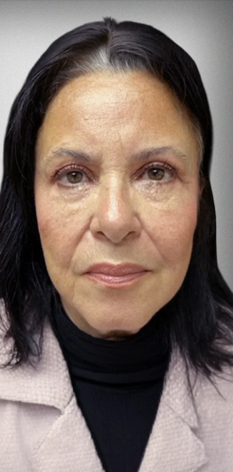 Eyelid Surgery8