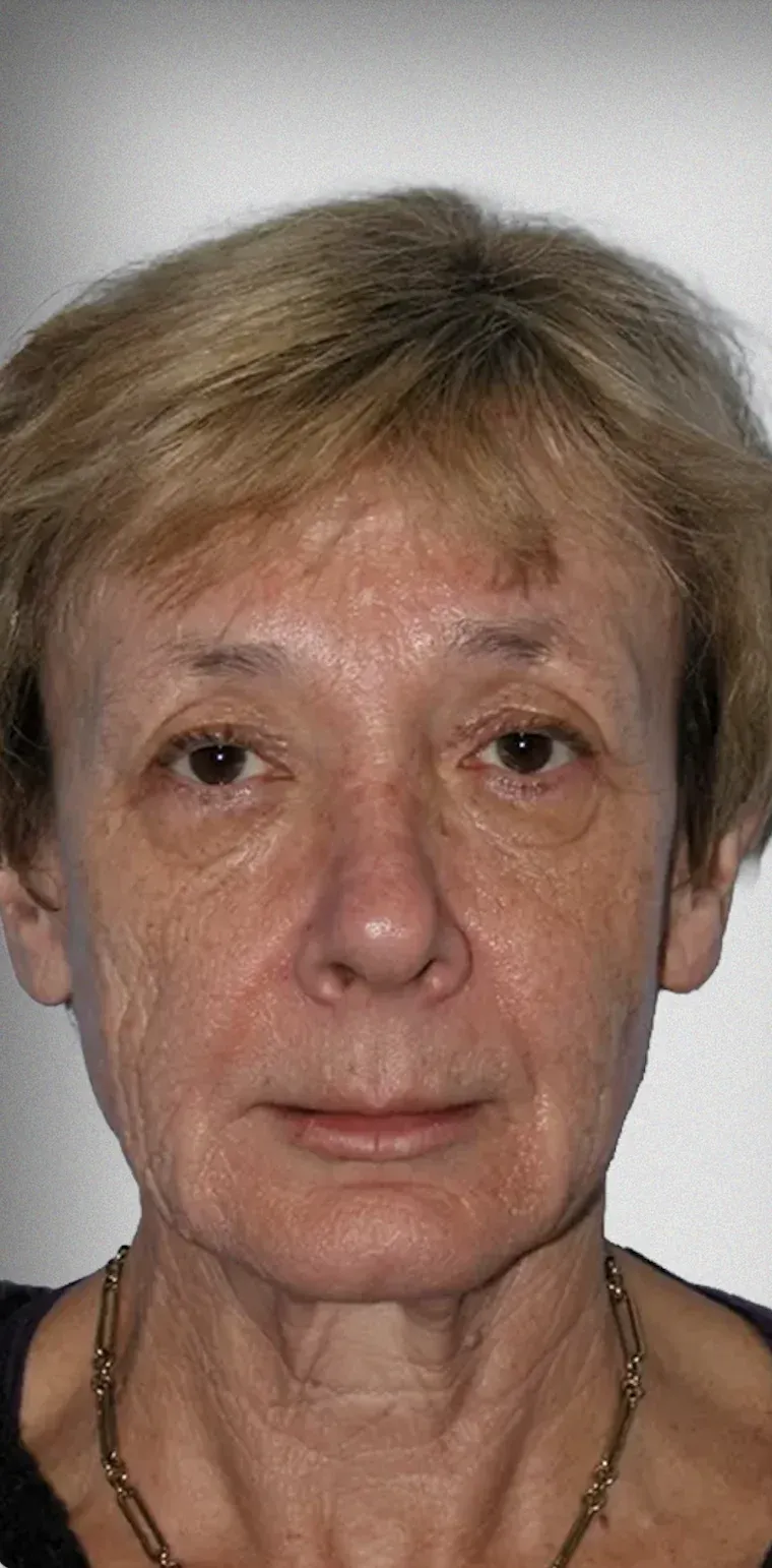 Facelift