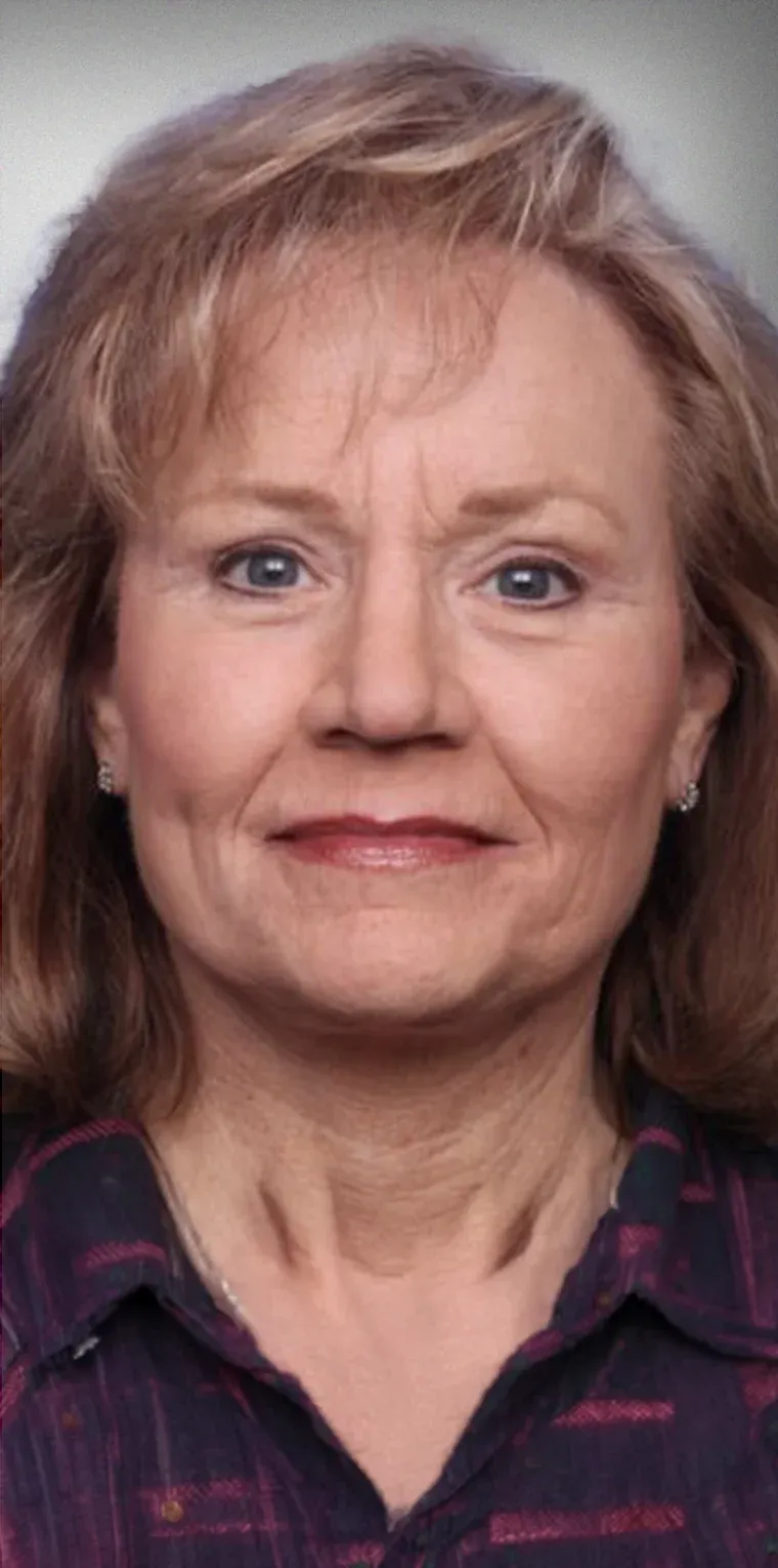 Facelift10