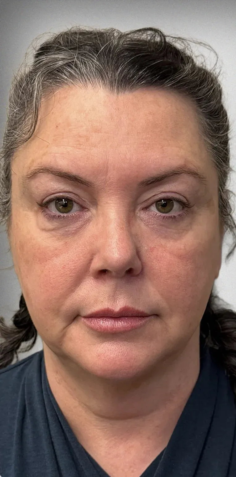 Facelift11