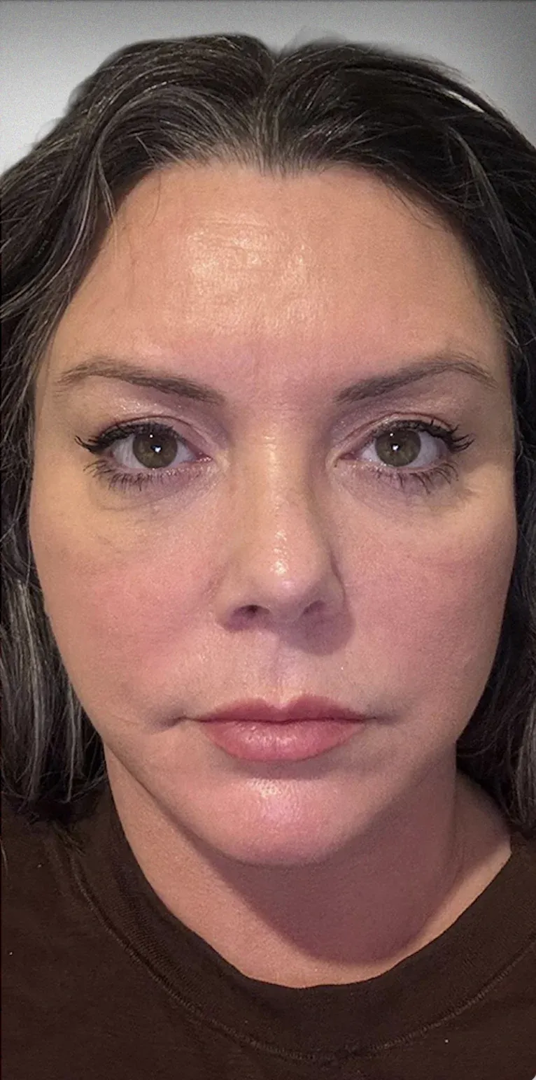Facelift12