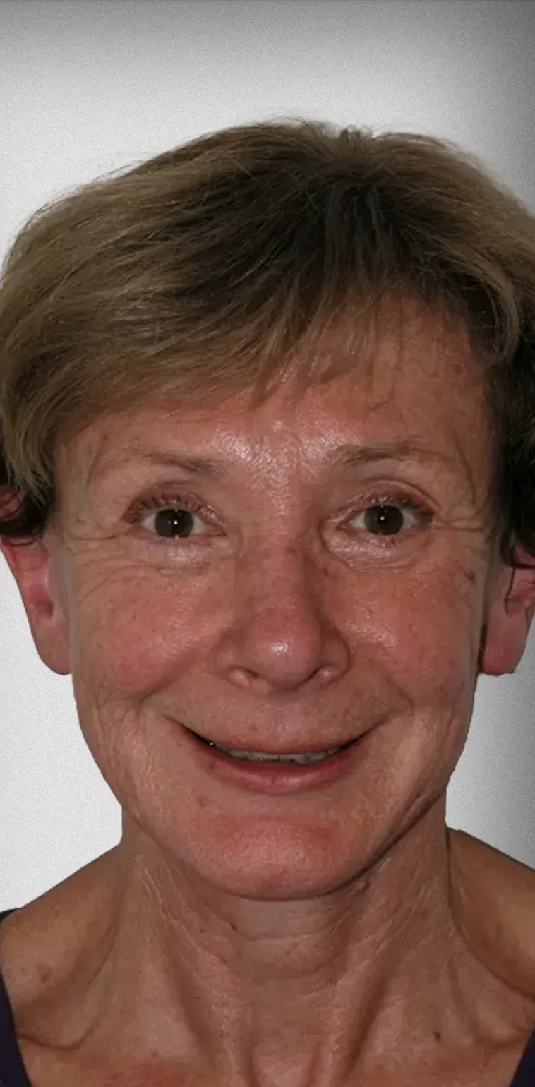 Facelift2