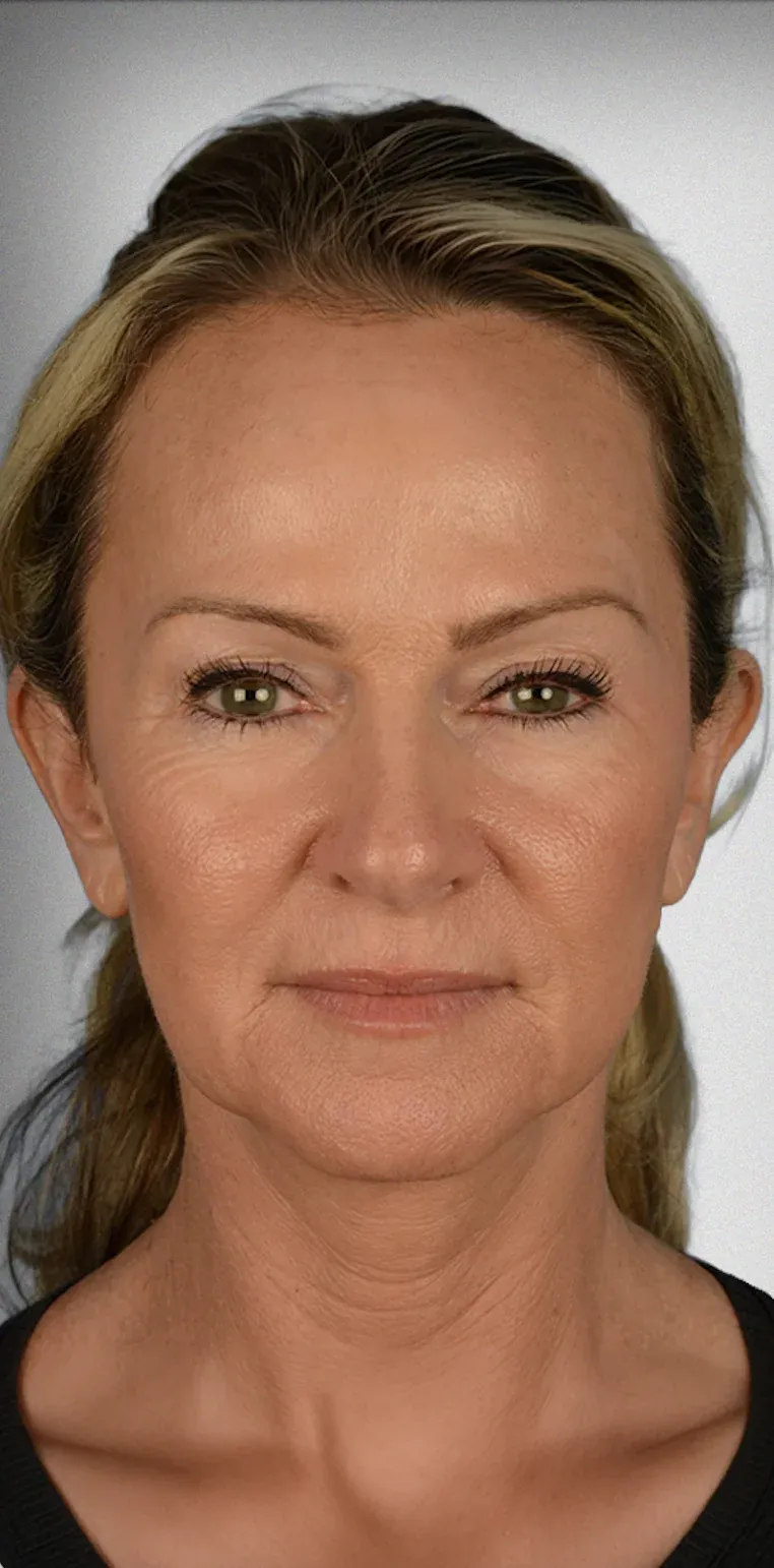 Facelift3