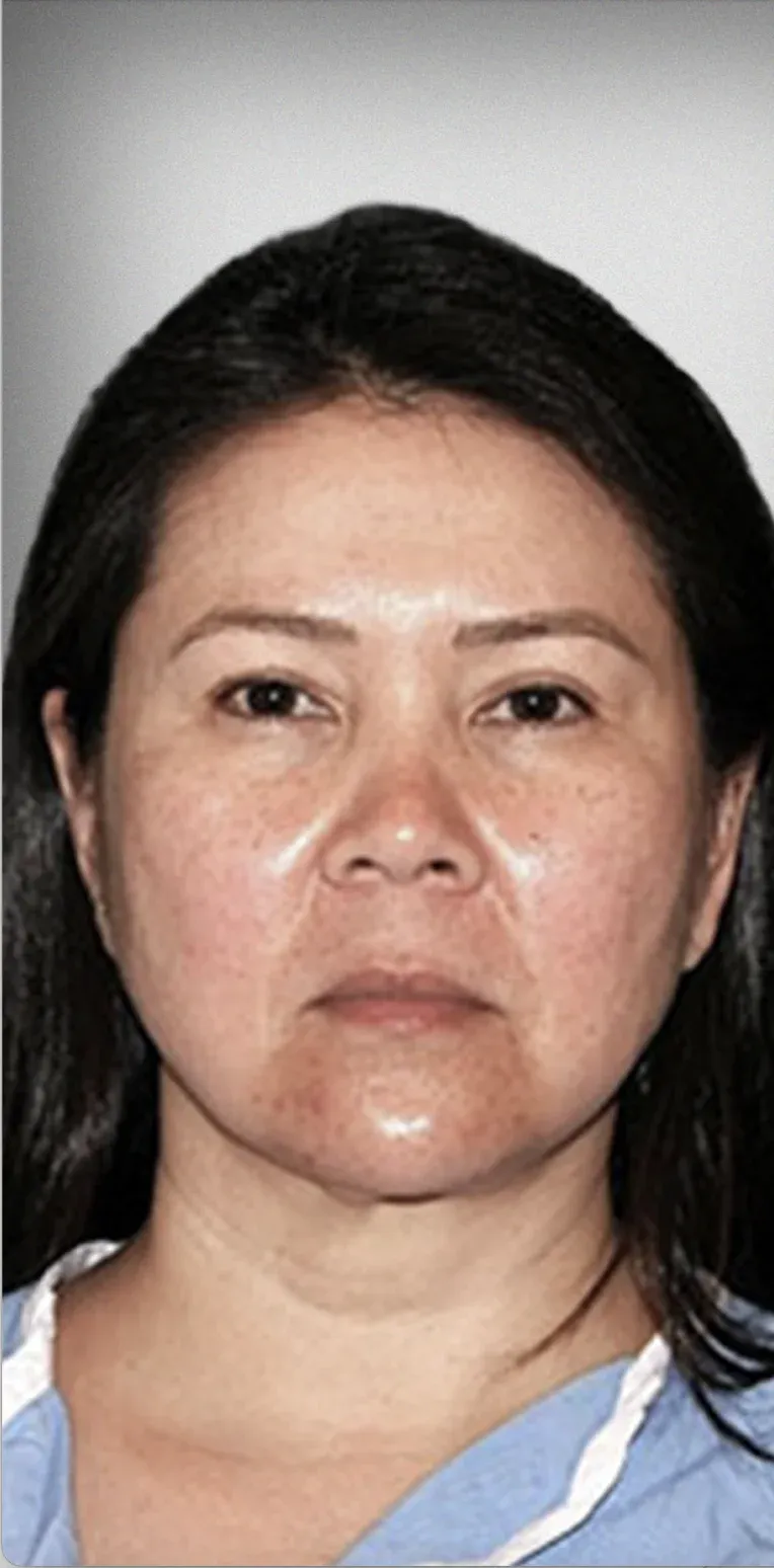 Facelift5