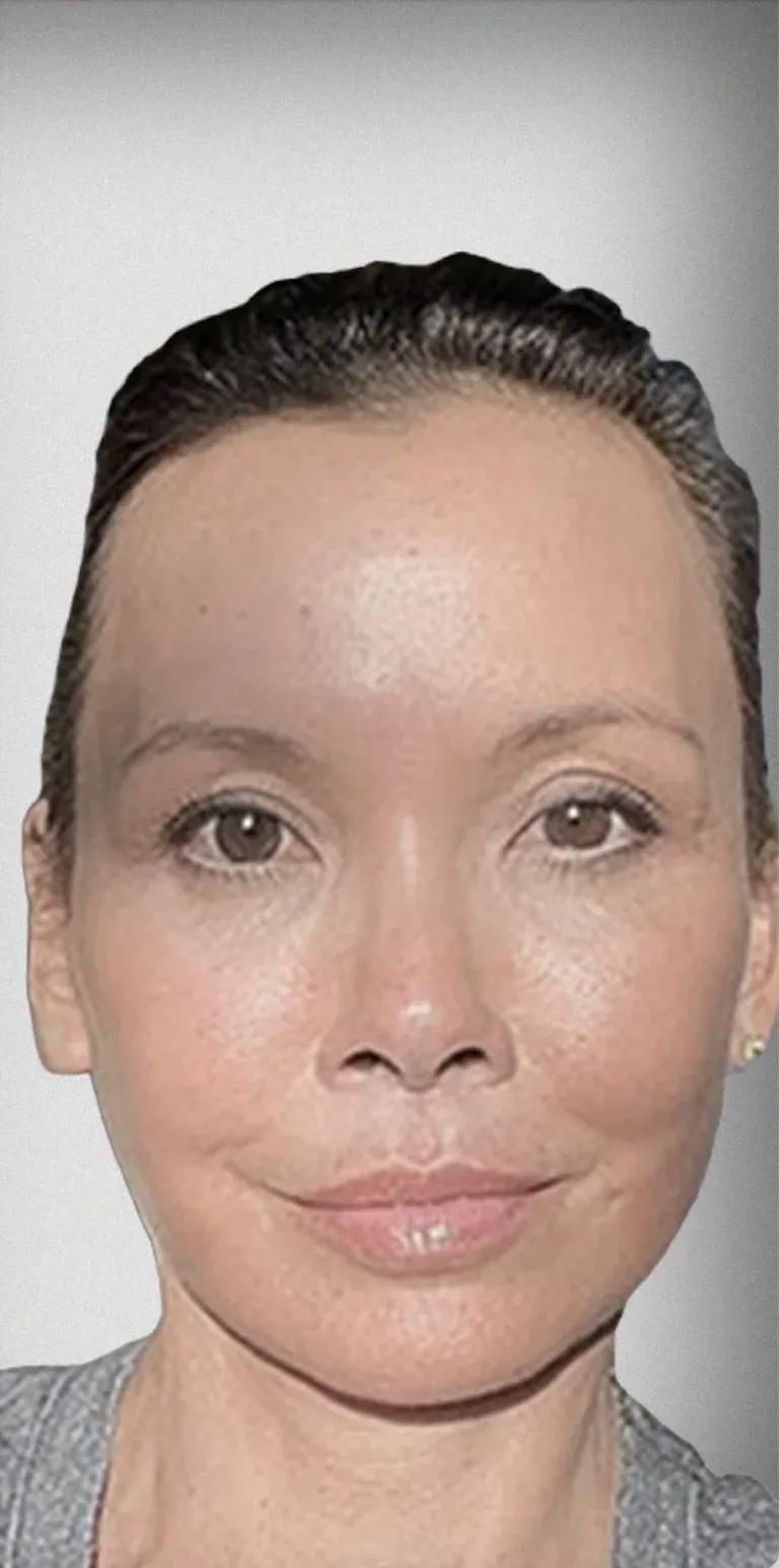 Facelift8
