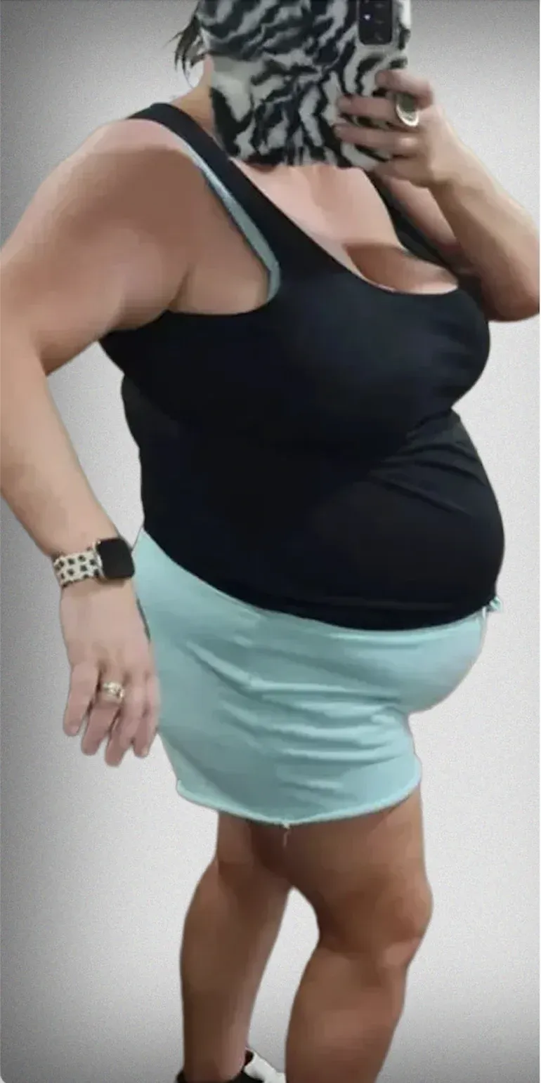 Gastric Balloon