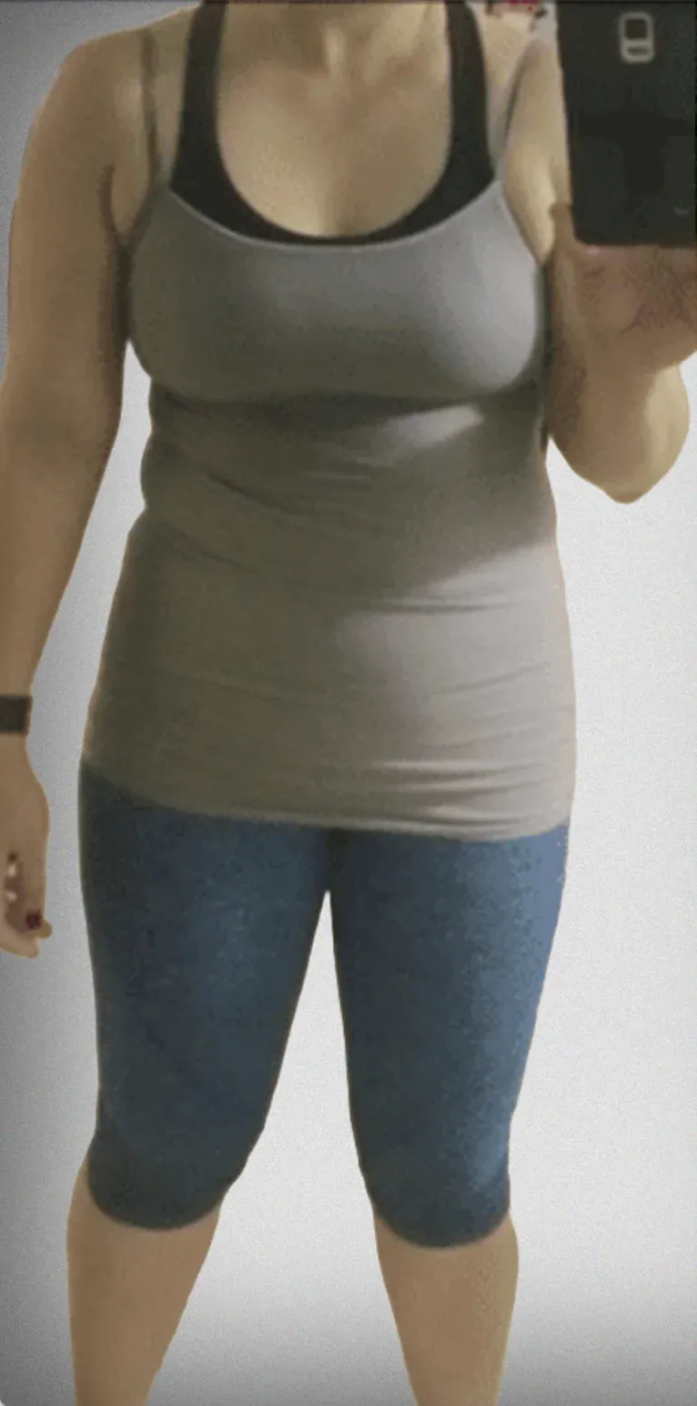 Gastric Balloon11