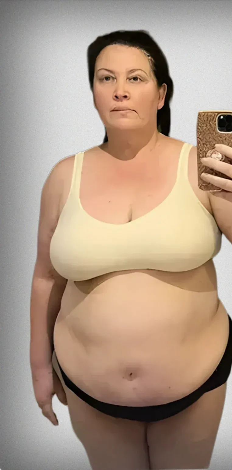 Gastric Bypass
