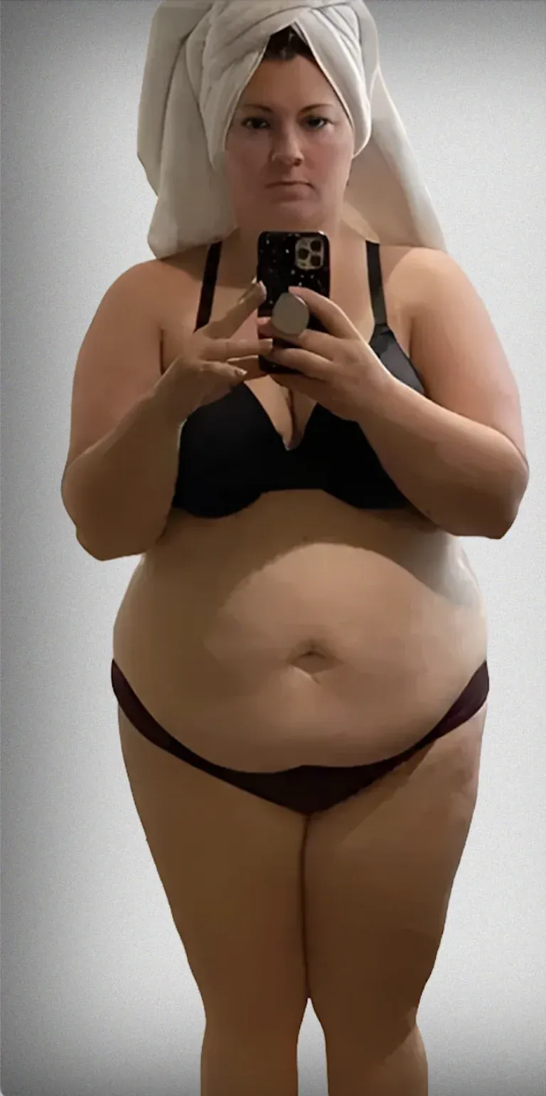Gastric Bypass11