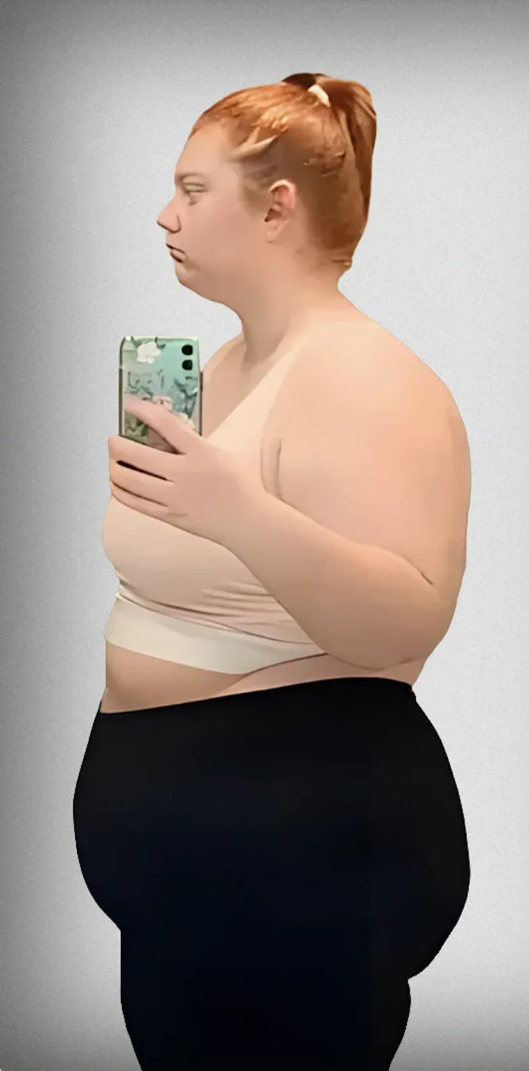 Gastric Bypass3