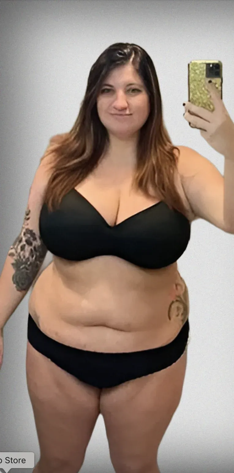 Gastric Bypass7
