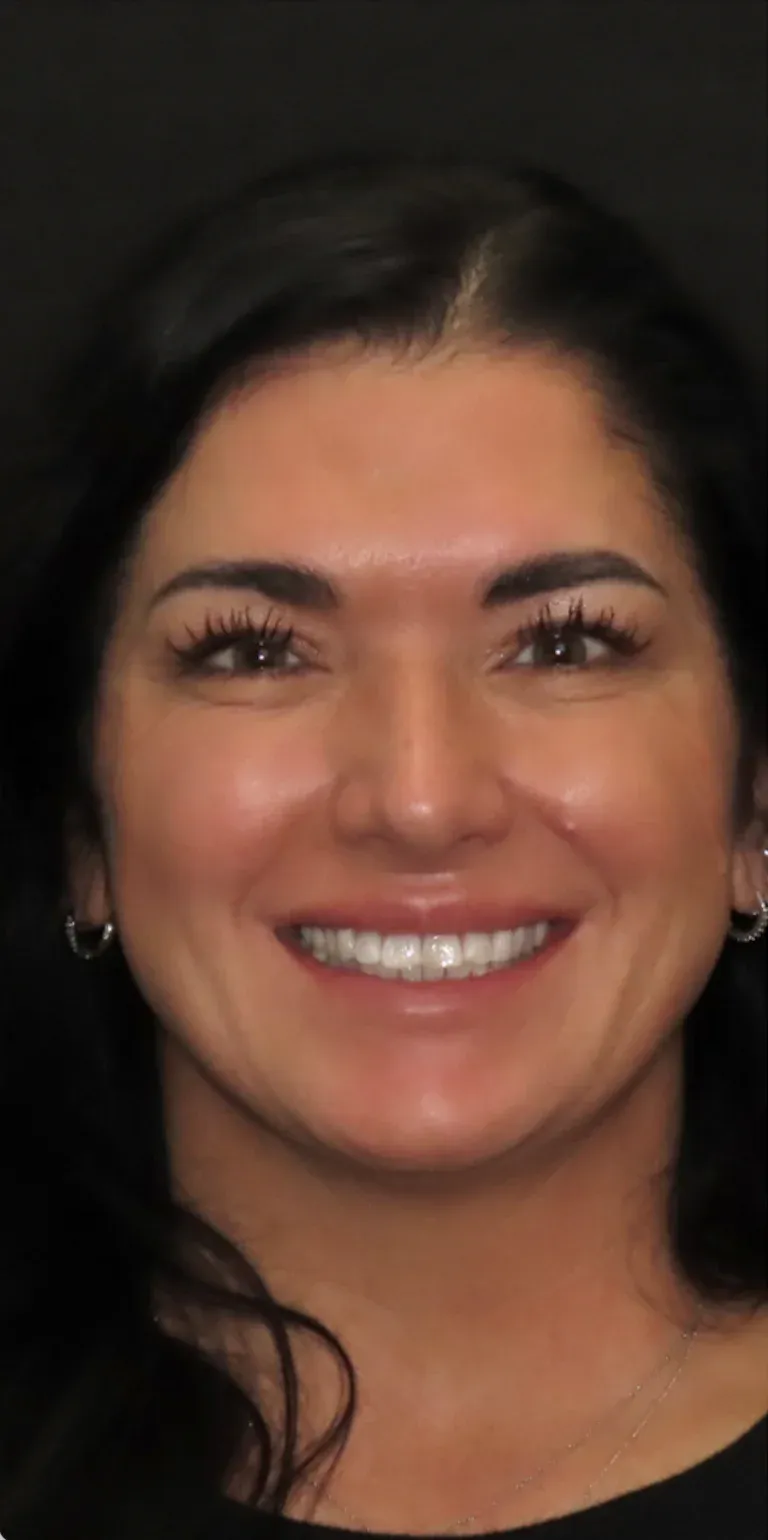 Hollywood smile before-after