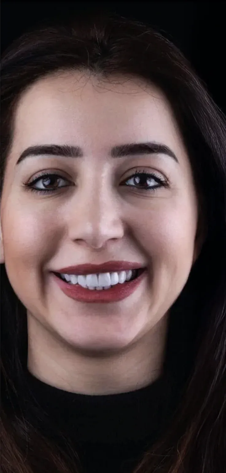 Hollywood smile before-after10