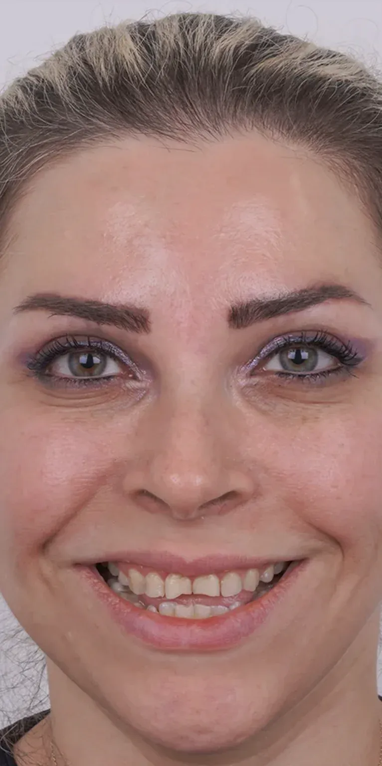 Hollywood smile before-after11