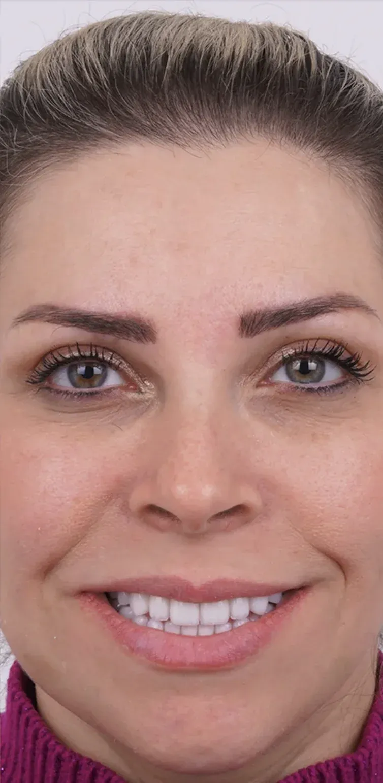 Hollywood smile before-after12