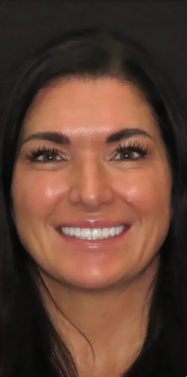 Hollywood smile before-after2