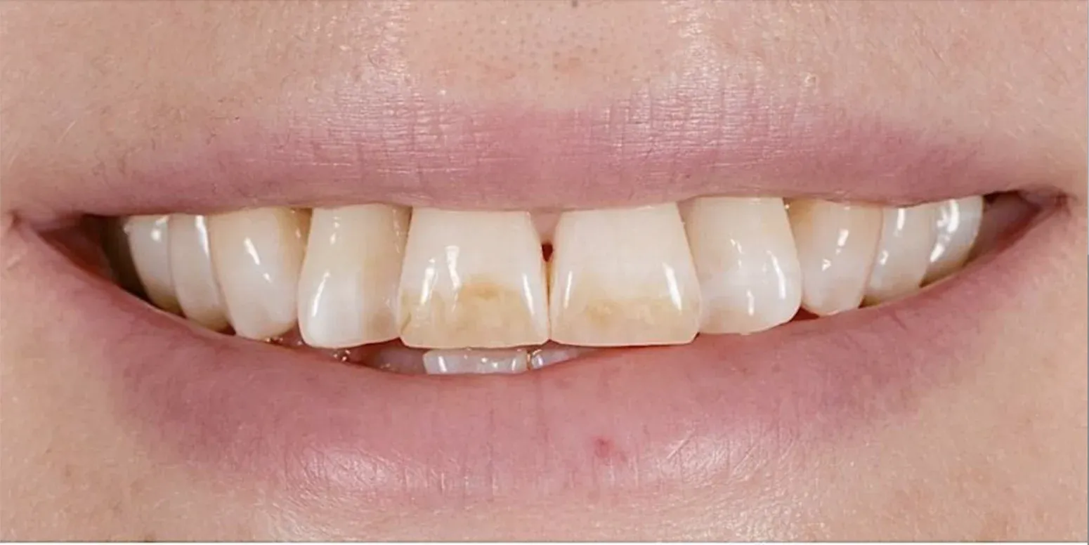 Hollywood smile before-after3