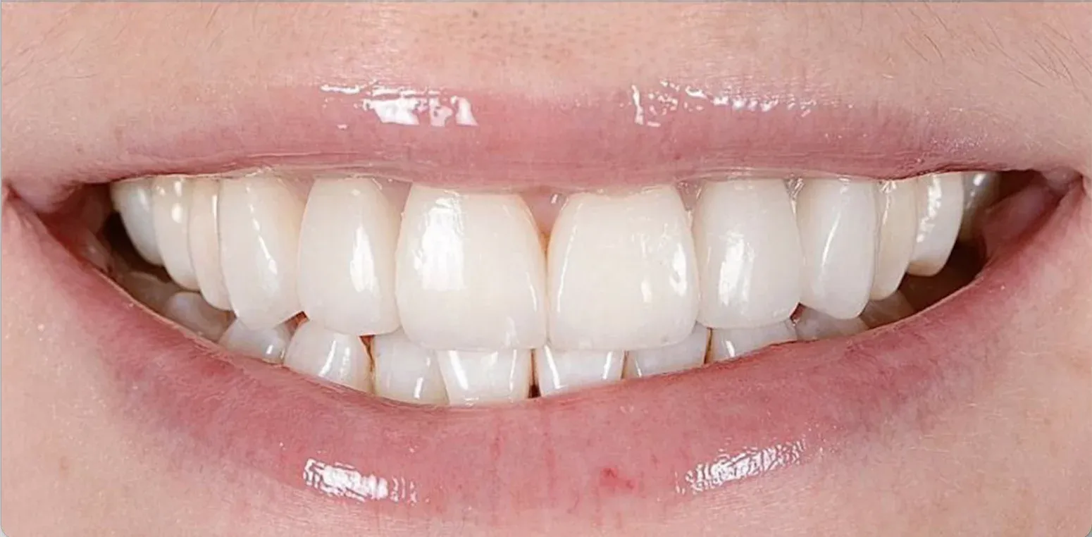 Hollywood smile before-after4