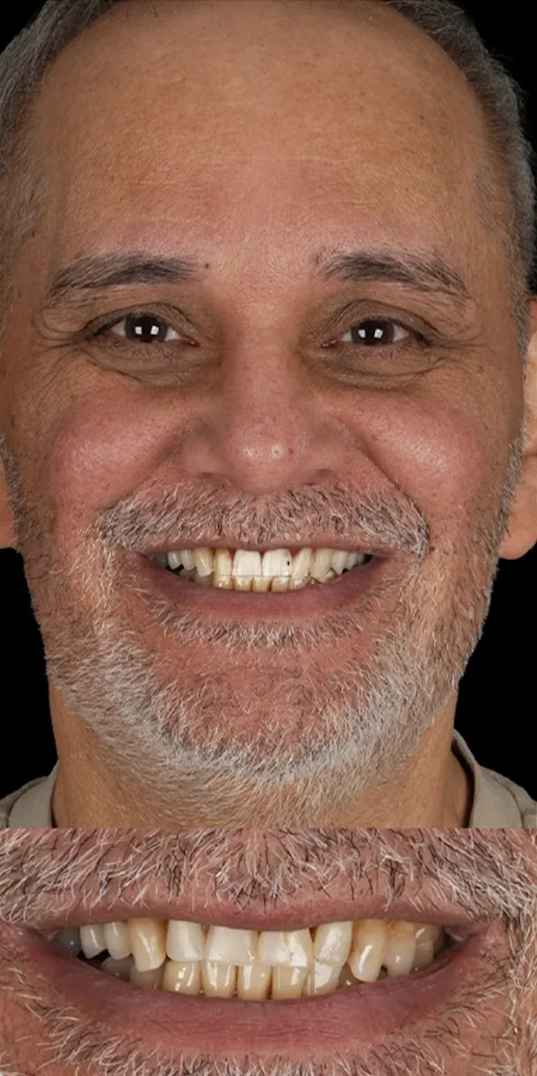 Hollywood smile before-after7