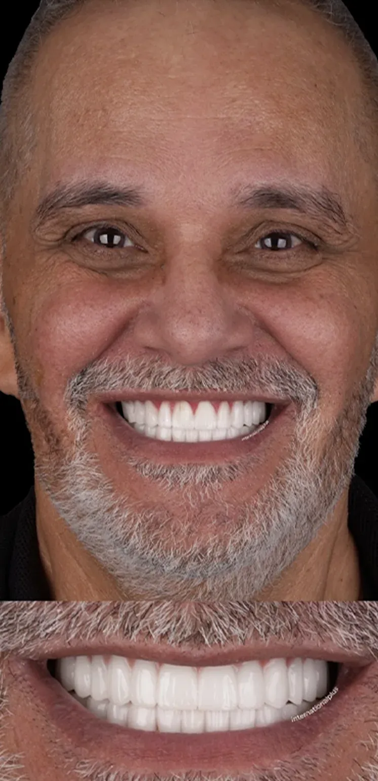 Hollywood smile before-after8