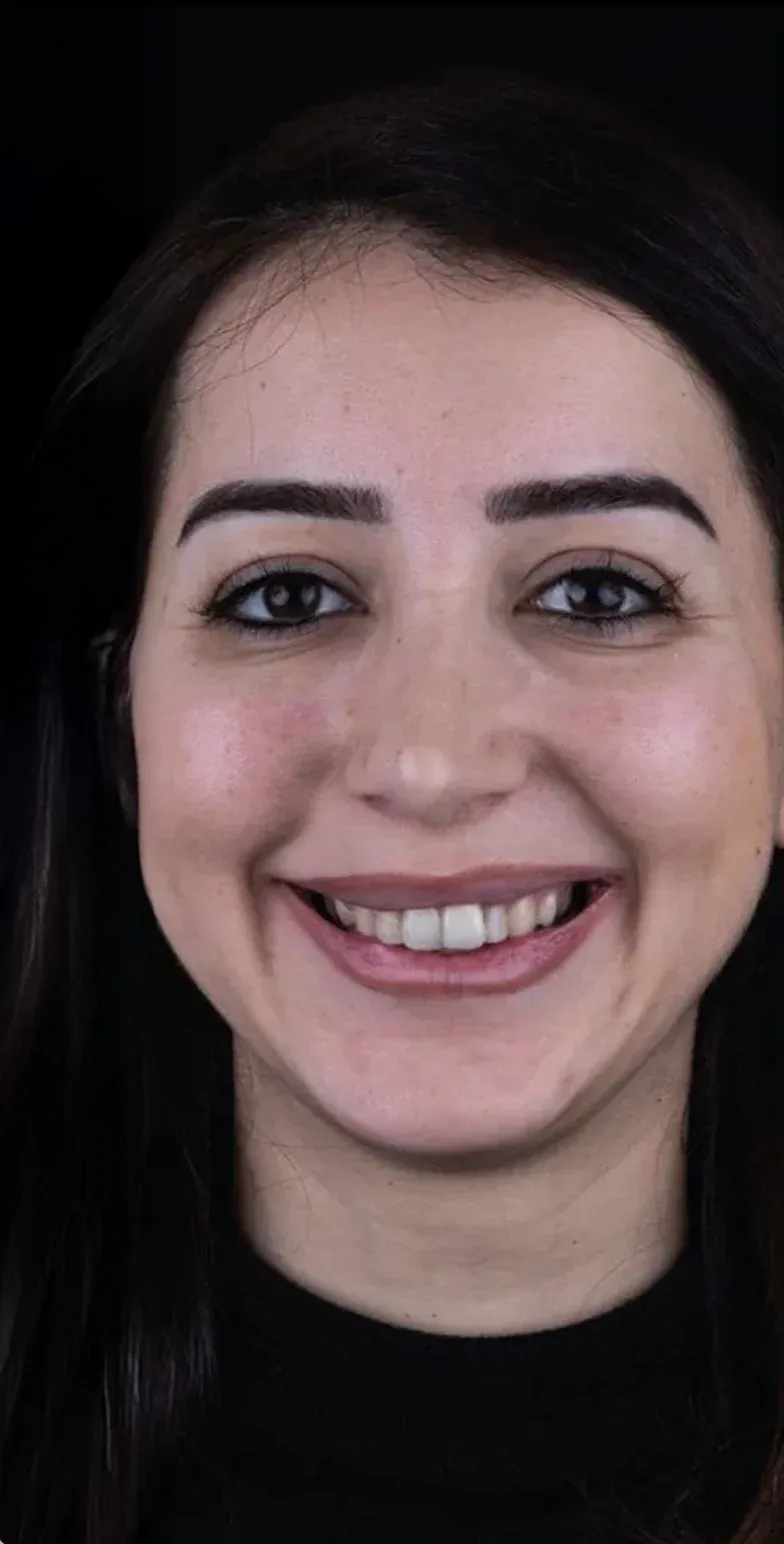 Hollywood smile before-after9