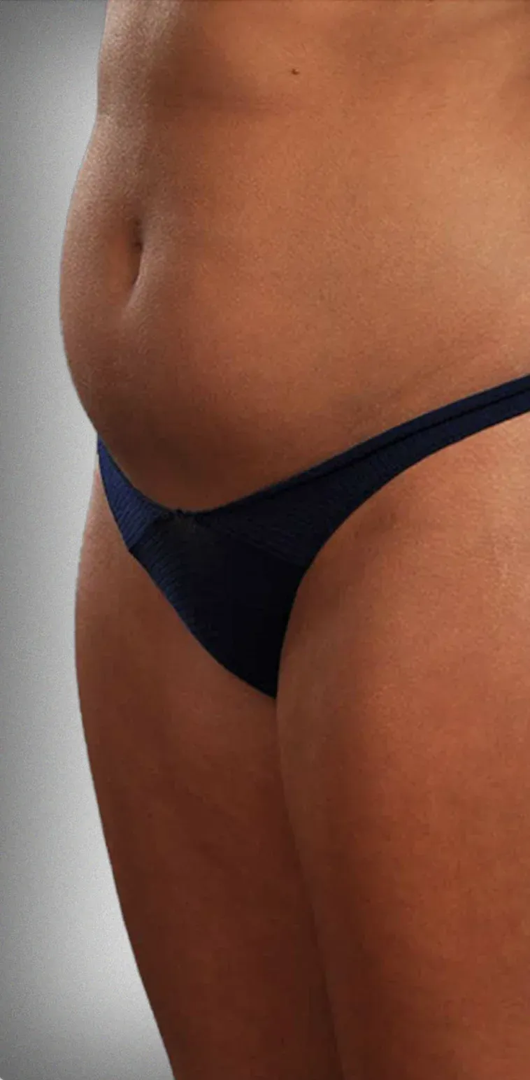 Liposuction
