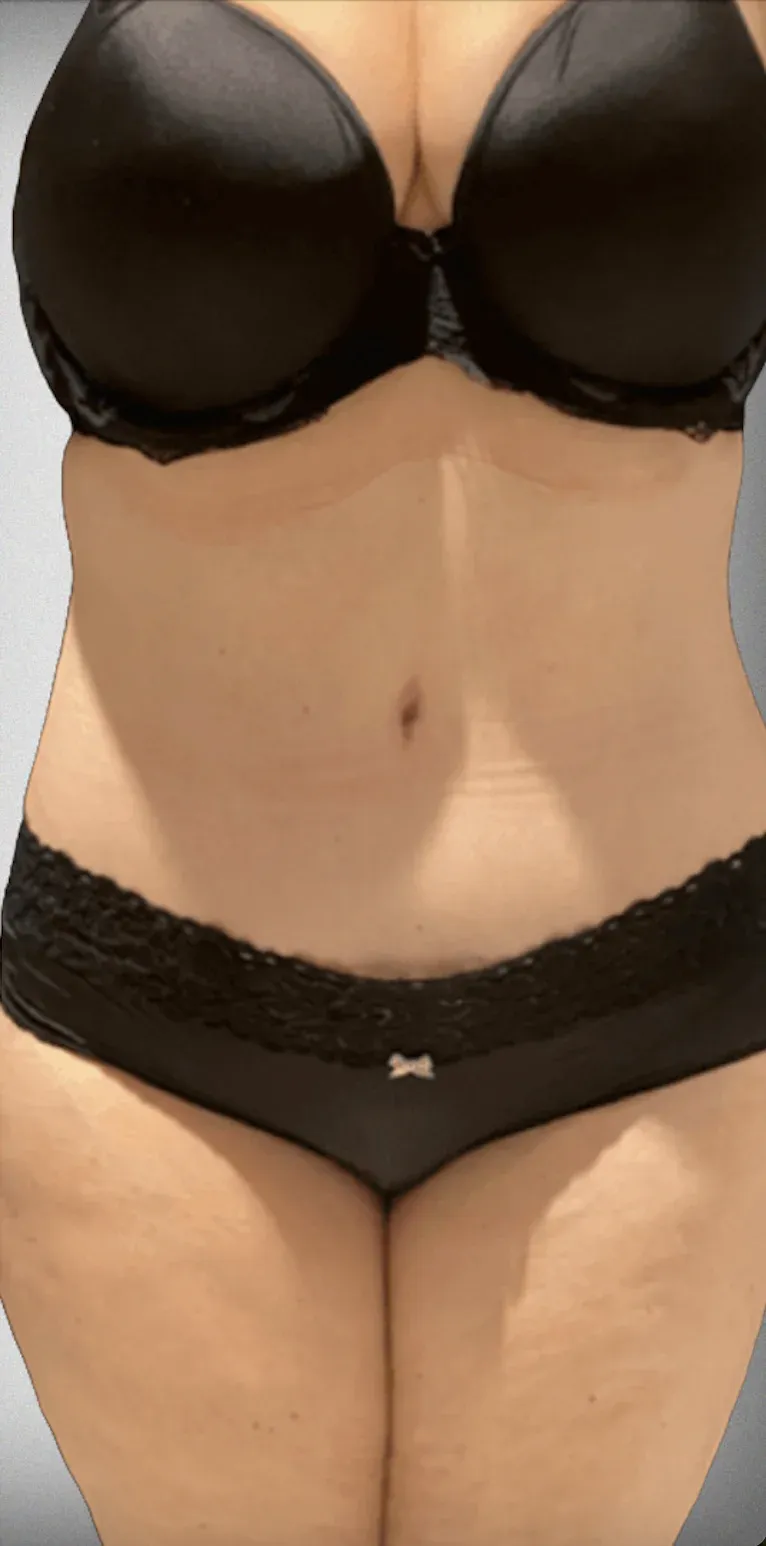 Liposuction10