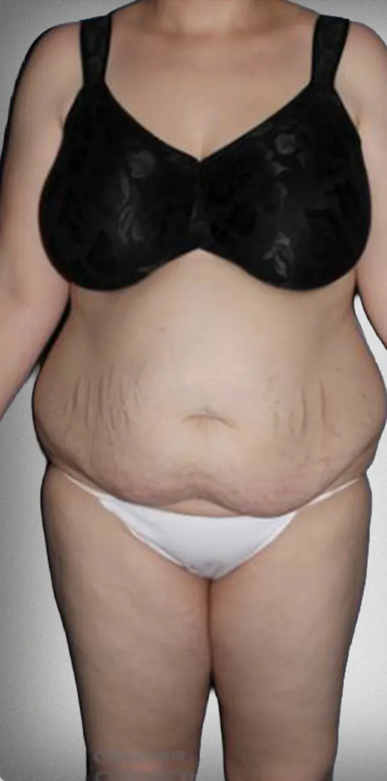 Liposuction11