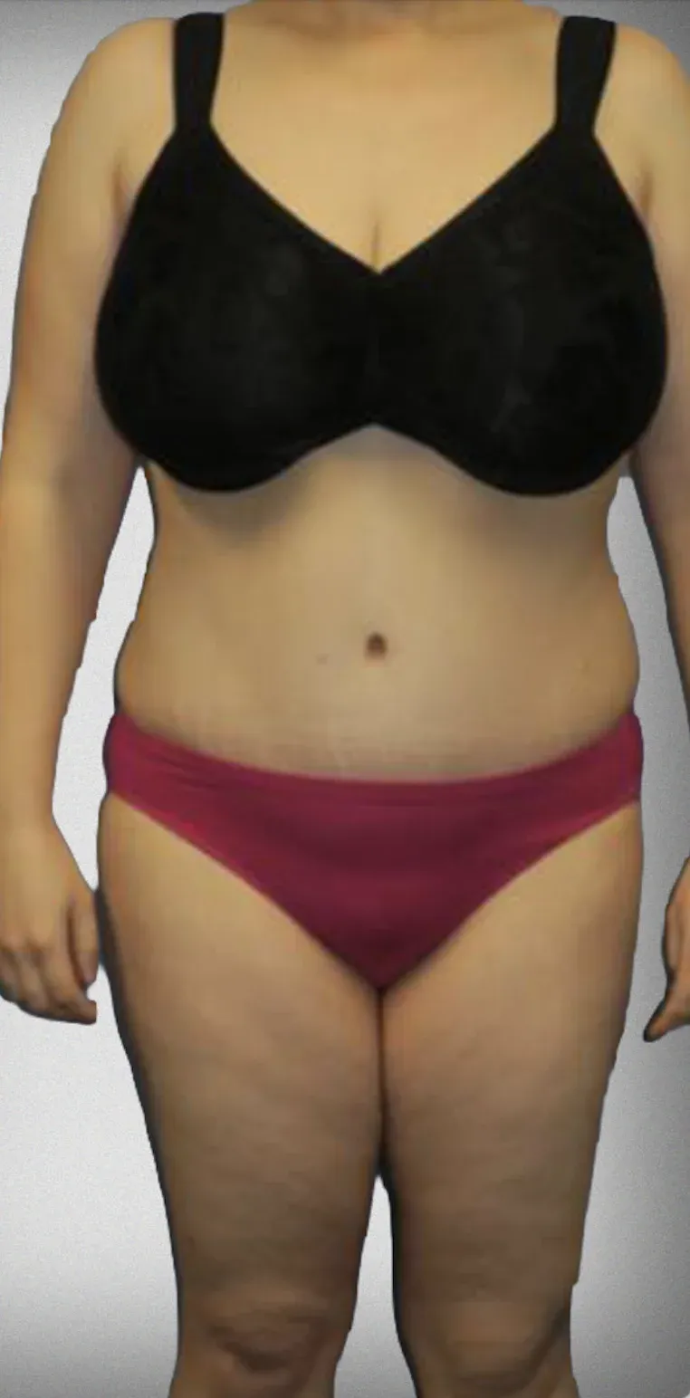 Liposuction12