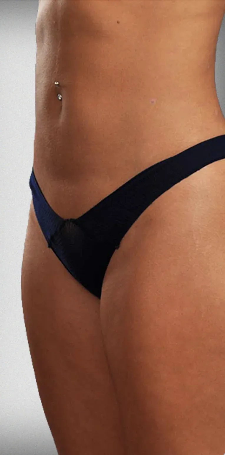 Liposuction