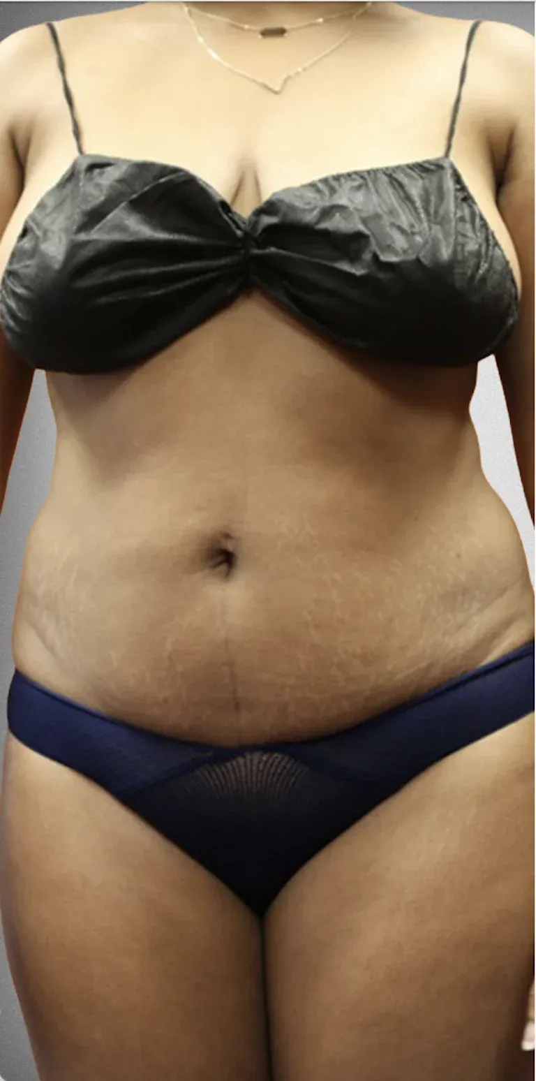 Liposuction3
