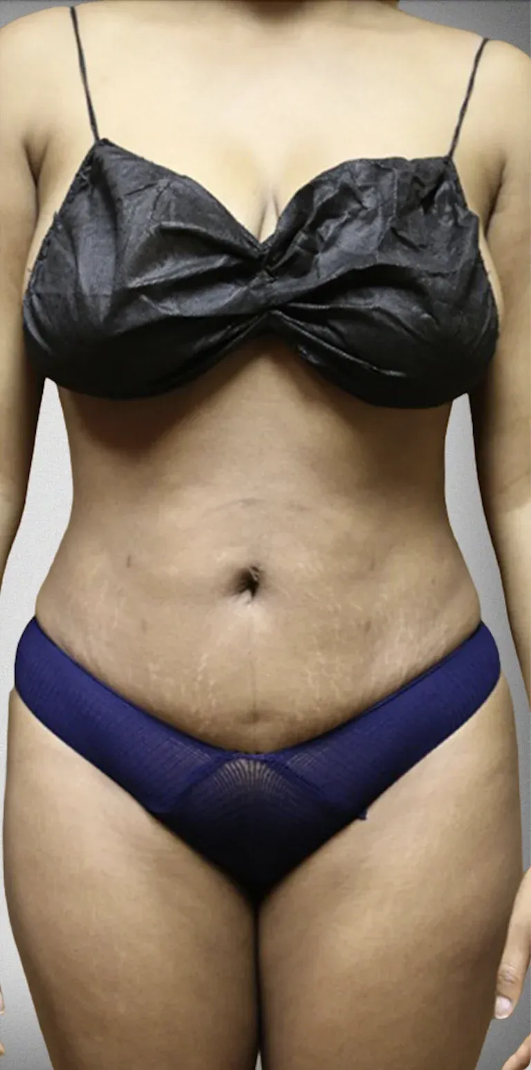 Liposuction4