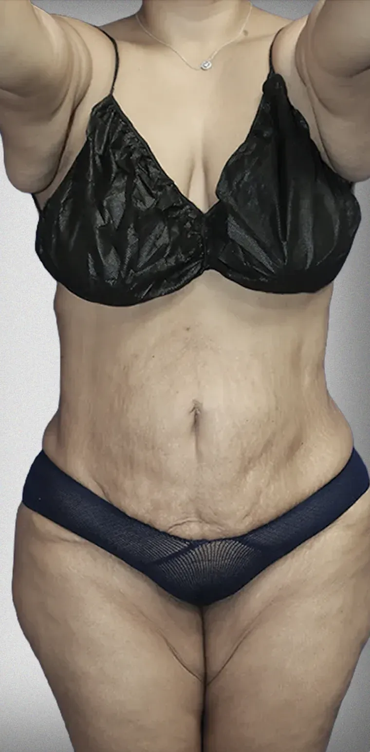 Liposuction6